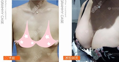 <!--<i data=20240705-sp></i>-->夏文豪曼托假体隆胸前后对比效果
