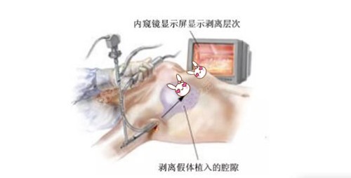 内窥镜丰胸技术