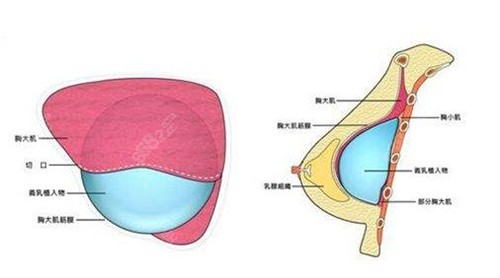 假体放置到胸大肌后层次柔软