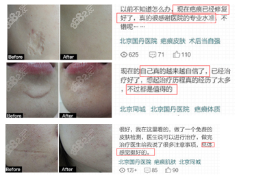 一些患者在北京国丹做疤痕的评价和效果参考