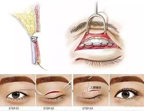 贝塞尔曲线双眼皮手术过程