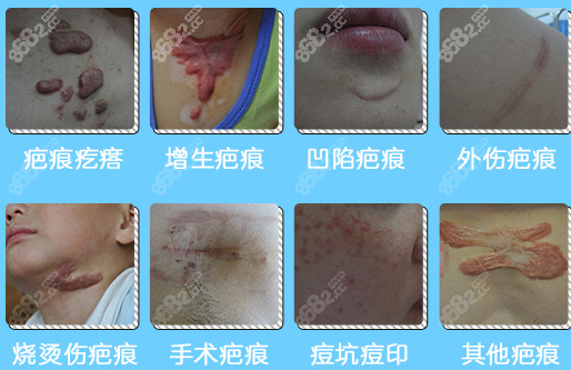 北京国丹医院去疤痕的类型示意图