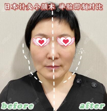 北京领医医疗美容日本针灸小颜术真人对比照