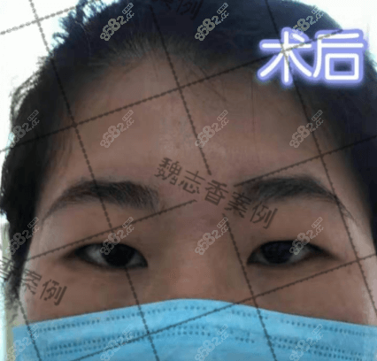 亲测魏志香双眼皮改单眼皮技术真是牛