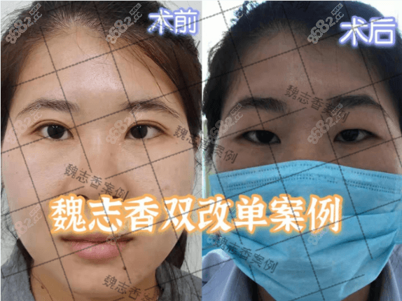 魏志香双眼皮改单眼皮效果