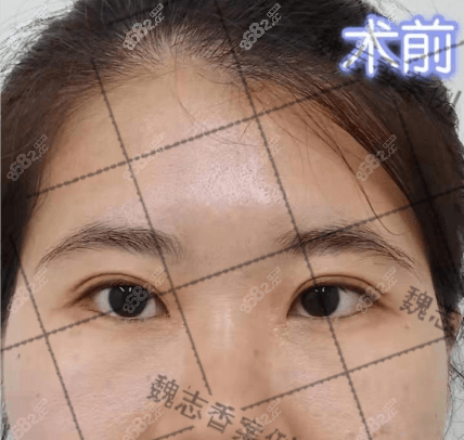 在北京丽星翼美做全切双眼皮改单眼皮前