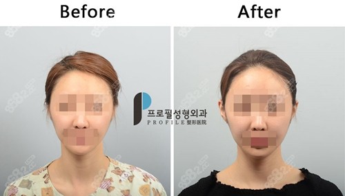 韩国profile普罗菲耳整形医院贴发耳矫正前后对比