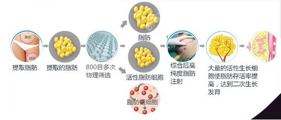 梁耀婵自体脂肪丰胸技术在北京名气大吗？