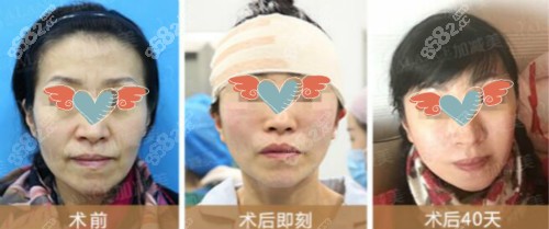 北京加减美黄寅守医生做的v9脸部提升效果图