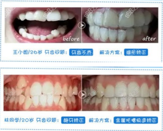 烟台华怡数字化口腔门诊部牙齿矫正效果图