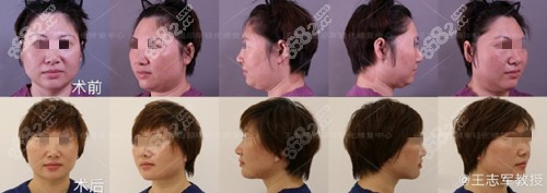 王志军拉皮手术效果图