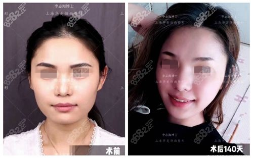 上海华美下颌角手术前后对比照