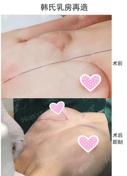 乳房再造手术前后效果对比