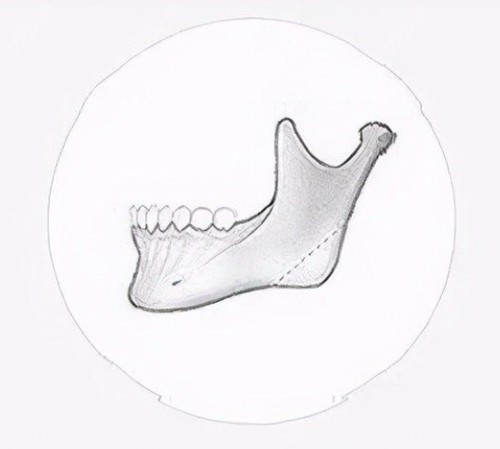 下颌角宽脸方磨骨好还是削骨好