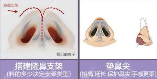 做双弧支架固定鼻头的柔软度