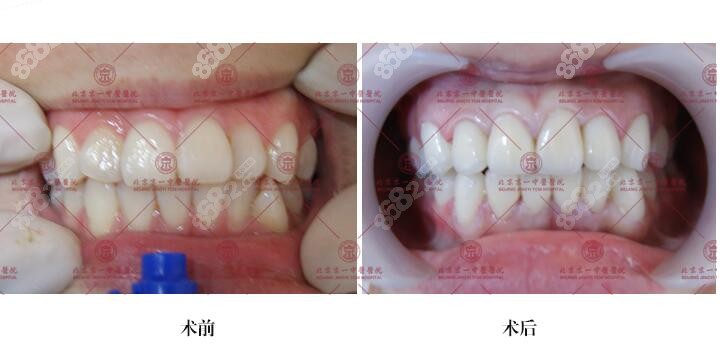 上文就是关于北京京一口腔医院种植牙及牙齿矫正的价格,真人效果图