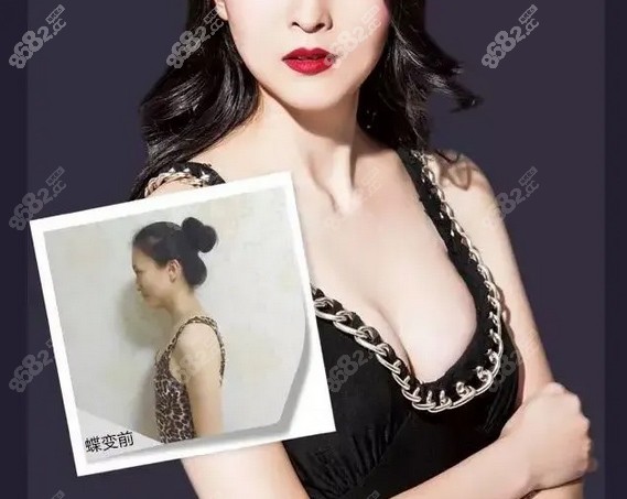 上海美莱汪灏隆胸前后对比照