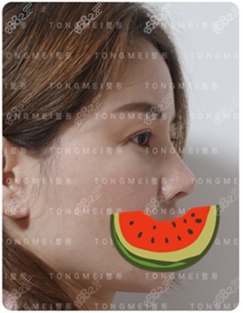 <!--<i data=20240705-sp></i>-->的鼻修复效果