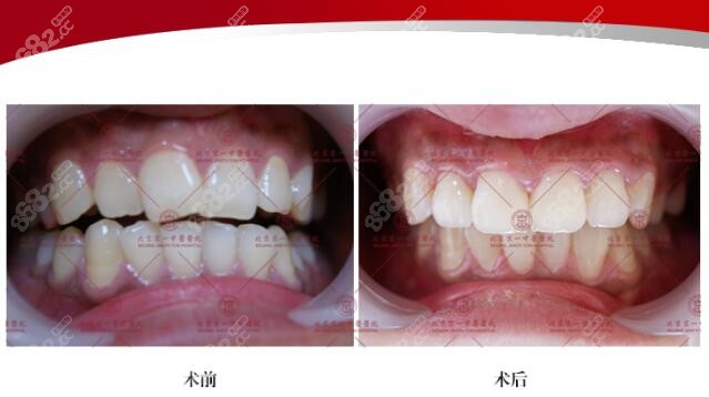 北京京一口腔医院门迎拥挤矫正效果图片