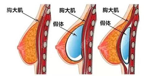 假体隆胸手术放置的层次