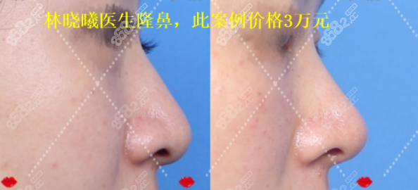 <!--<i data=20240705-sp></i>-->医生做的隆鼻效果图1