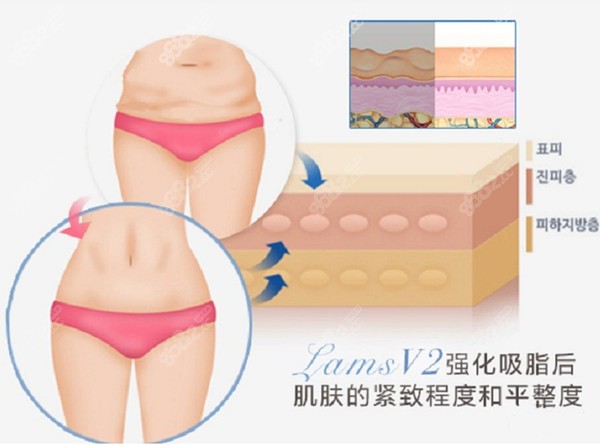 兰斯抽脂能保障皮肤的平整度