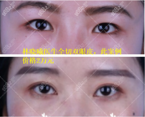 <!--<i data=20240705-sp></i>-->医生做双眼皮的效果图
