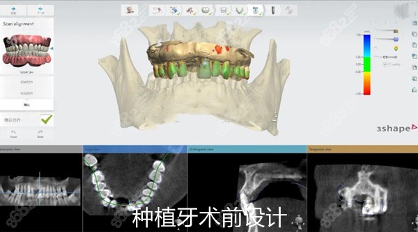 种植牙术前电脑设计方案