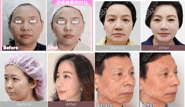 <!--<i data=20240705-sp></i>--><!--<i data=20240705-sp></i>-->醫(yī)生做的速提美<span style=