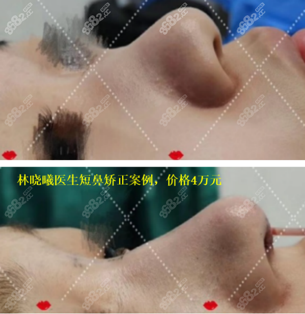 <!--<i data=20240705-sp></i>-->医生做隆鼻手术的即刻效果图