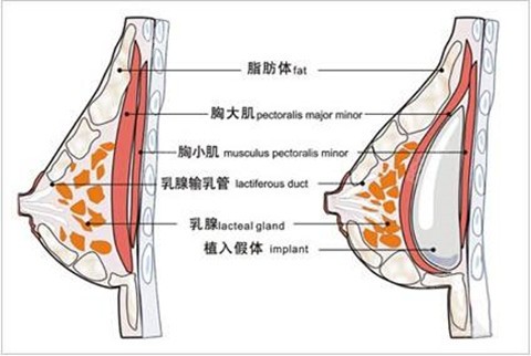 宁波壹加壹隆胸优势