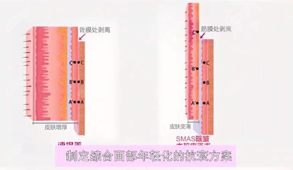 速提美手术和传统拉皮手术的区别