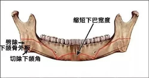 下颌角位置图片图片