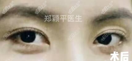 割双眼皮术后1个月效果照