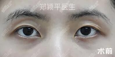 割双眼皮术前照