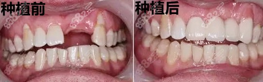 种植牙前后对比