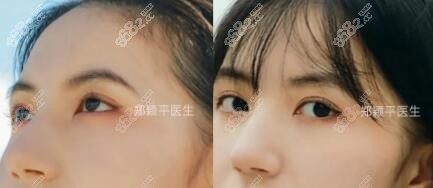 割双眼皮术后60天效果照