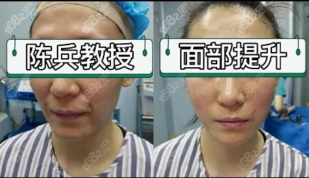 <!--<i data=20240705-sp></i>-->做的拉皮前后<span style=