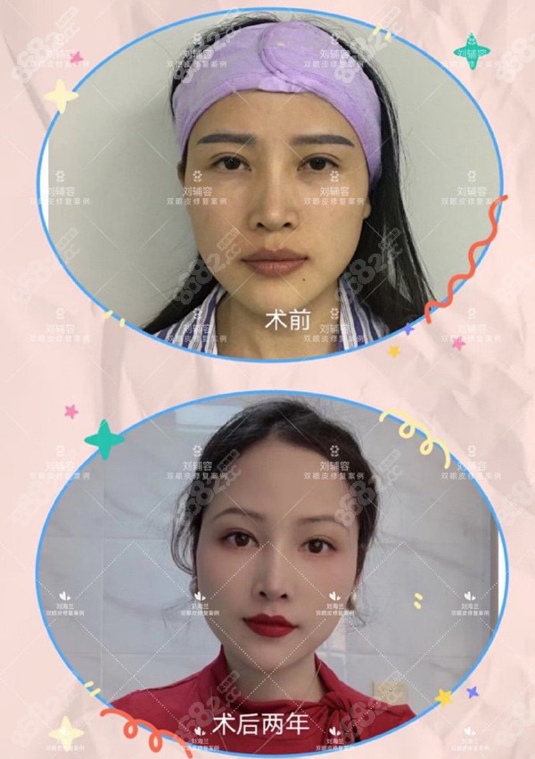 雙眼皮修復(fù)對(duì)比照：改善瞳孔暴露度，平扇改開(kāi)扇形