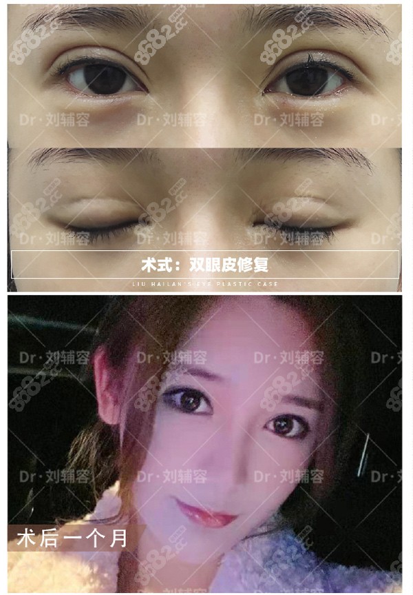 雙眼皮寬改窄分享：肉條眼，切口深，閉眼疤痕