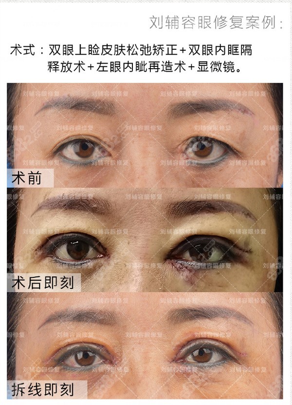 高難度雙眼皮內(nèi)眼角分享