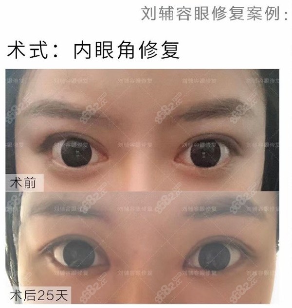 內(nèi)眼角修復(fù)分享：術(shù)前內(nèi)眼角開(kāi)的過(guò)大，露紅