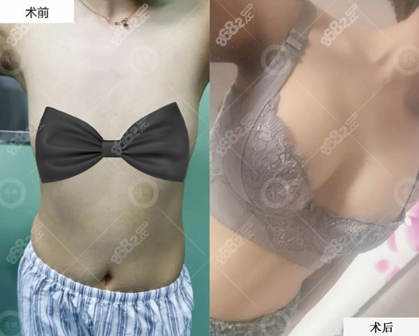 <!--<i data=20240705-sp></i>-->做脂肪丰胸的对比图