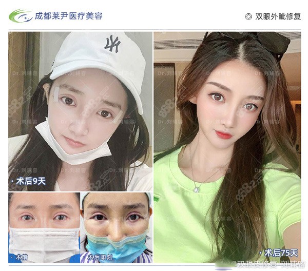 術(shù)前外眥露紅較重，豁口大，外眼角修復(fù)