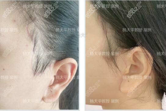 楊大平醫(yī)生做小切口耳前疤痕恢復(fù)半年效果圖片