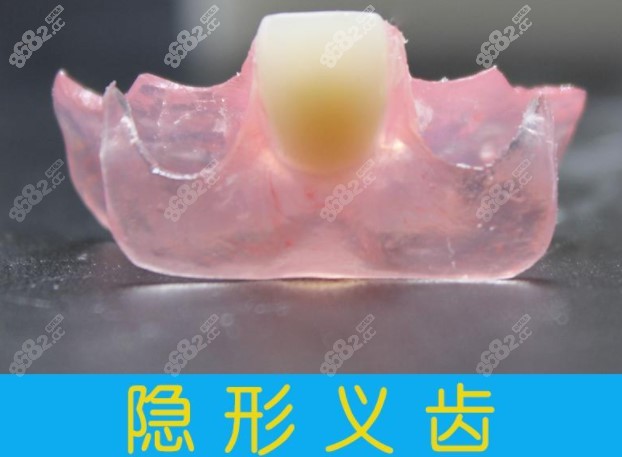 活动义齿图片