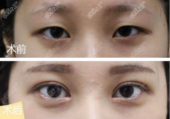 顾斌医生做双眼皮的术后效果图