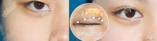 顾斌医生做双眼皮的真人效果图