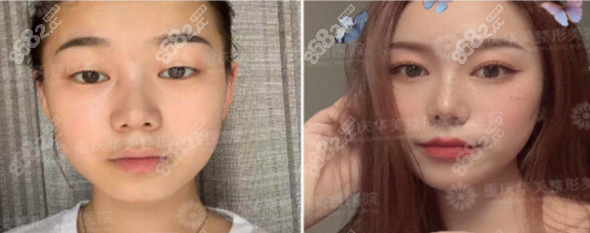 陈凯医生做的达芬奇美眼效果图