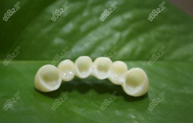 六连冠全瓷牙照片